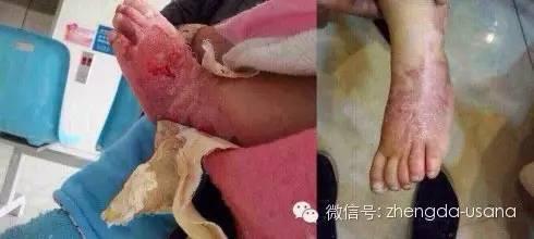 成人疝气调理案例视频大全,见证康复奇迹